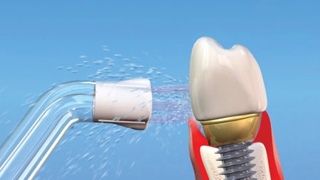 Dental Implant Maintenance: A Complete Guide Dental Implant Maintenance: A Complete Guide