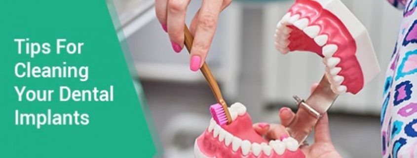 How to Keep Your Dental Implants Clean or Hygienic - AMD Dental Clinic