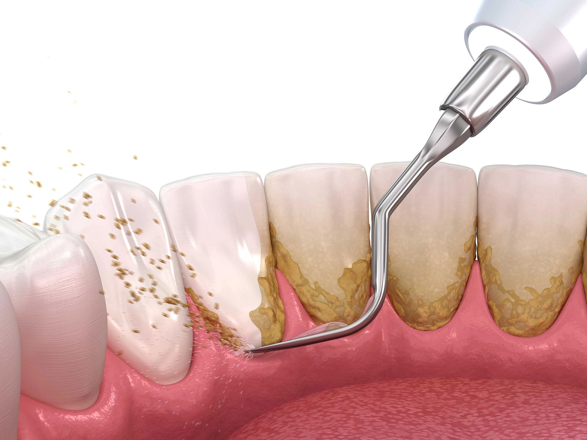 How Often Should You Get Teeth Scaling Done? How Often Should You Get Teeth Scaling Done?