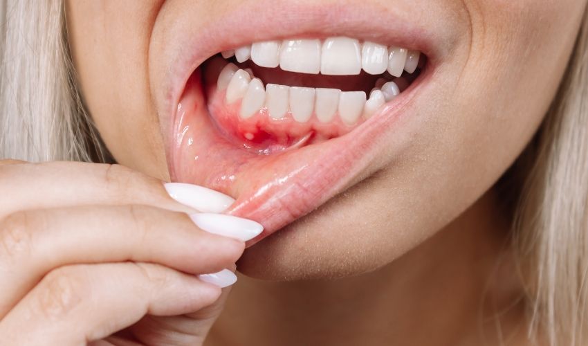 10 Home Remedies To Cure Mouth Ulcers