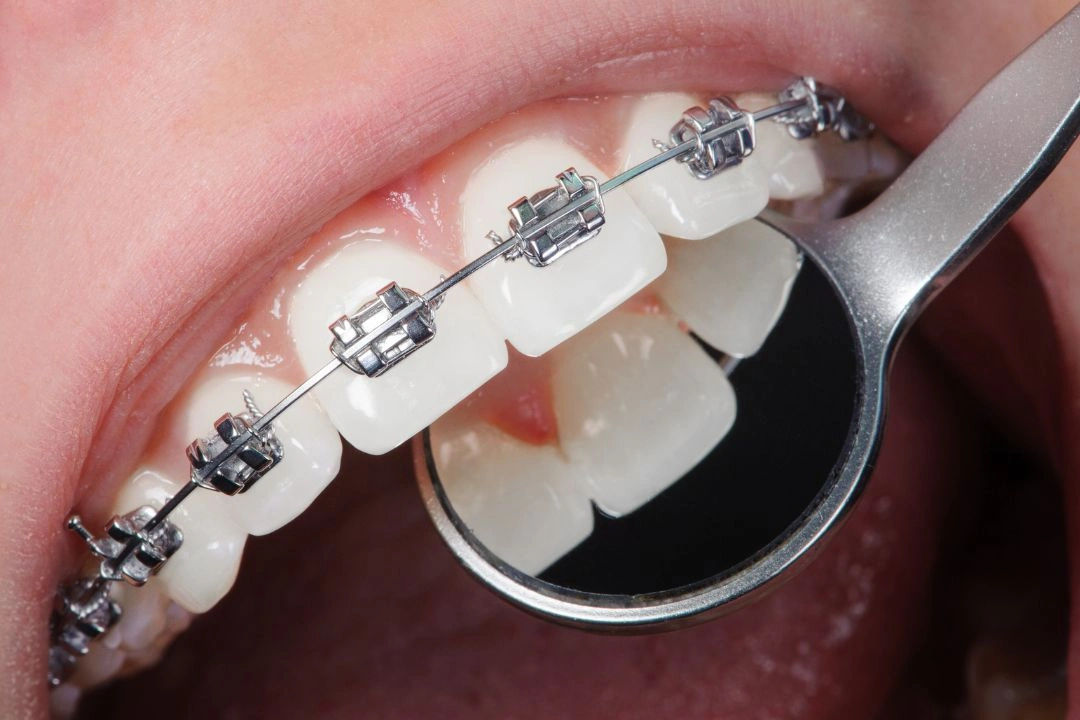 Top 7 Benefits of Choosing Metal Dental Braces for Teeth Correction Top 7 Benefits of Choosing Metal Dental Braces for Teeth Correction