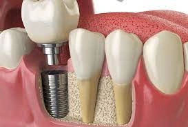 When Should You Consider Dental Implants? When Should You Consider Dental Implants?