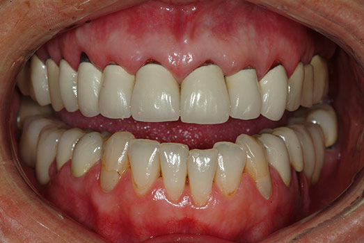  How Does Tooth Decay Happen Under A Dental Crown? 