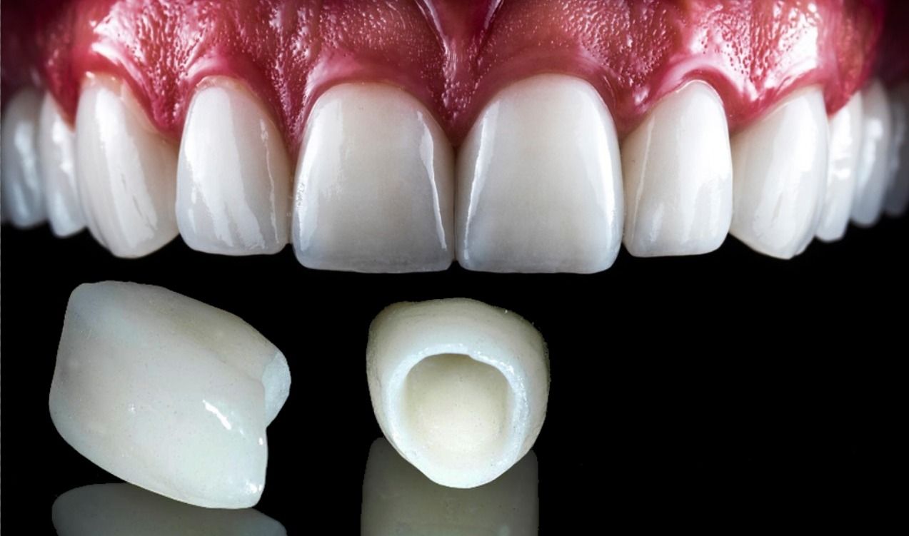 Difference Between Porcelain and Zirconia Crown