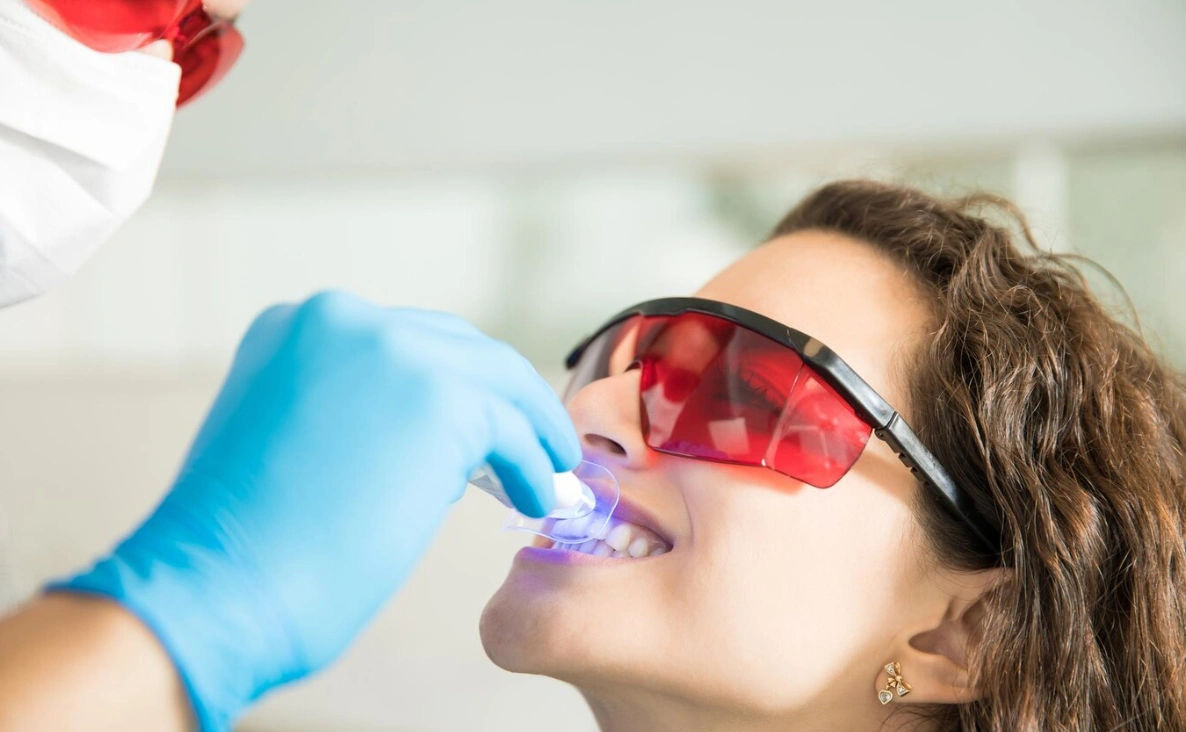 Best Time to Get Teeth Whitening Done in Jaipur – Why Monsoon Works Best Time to Get Teeth Whitening Done in Jaipur – Why Monsoon Works
