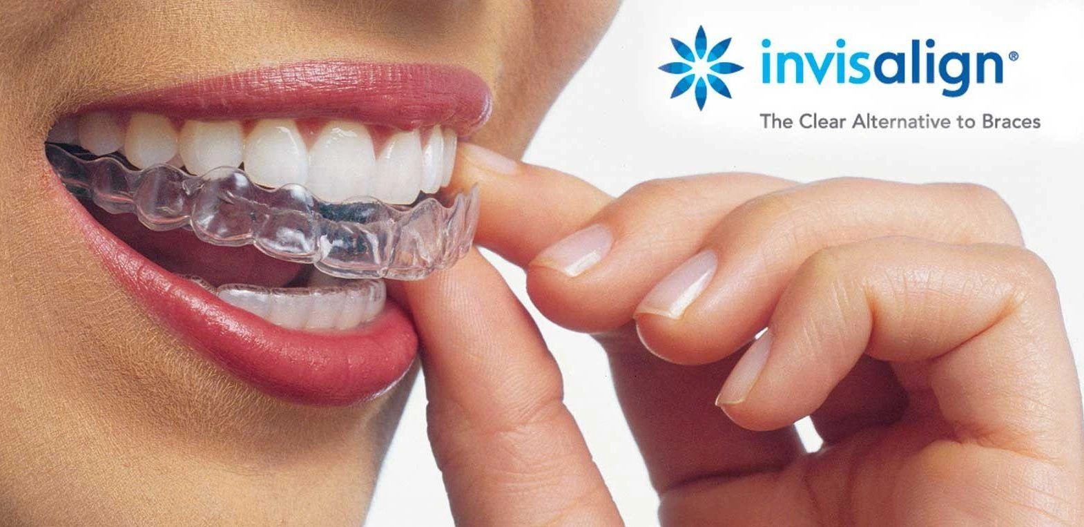 Best Invisalign Dentist in Jaipur – Why AMD Dental Clinic Is Trusted for Clear Braces & Smile Correction
