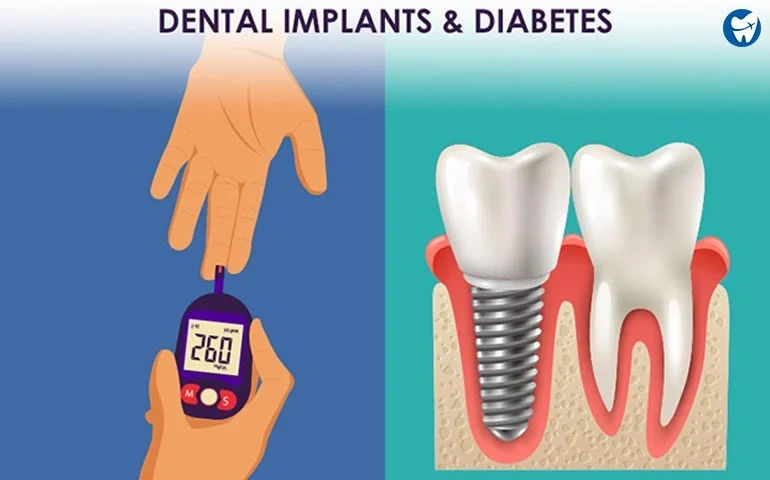 How Diabetes Affects Dental Implants & Gum Health