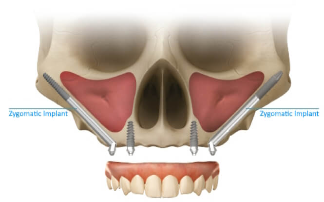 The Role of Zygomatic Implants in Full Arch Rehabilitation: Clinical Insights