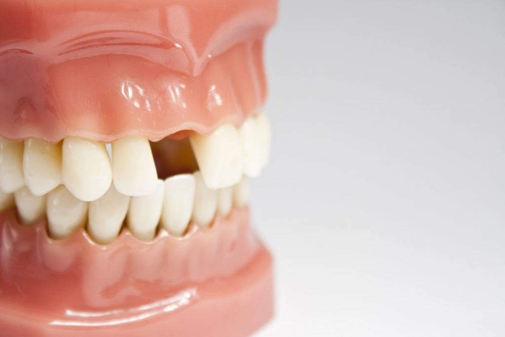 Not Replacing Missing Teeth? Here’s What Will Happen in 6 Months