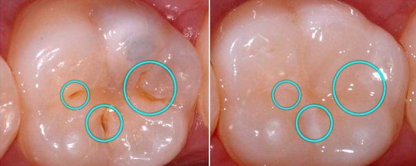 Dental Sealants: An Important Line of Protection Against Cavities