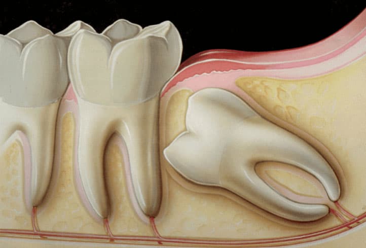 what-to-eat-after-wisdom-tooth-removal