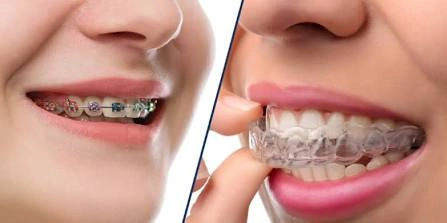 Invisalign vs. Traditional Braces: Cost, Comfort, and Choosing the Best Option for Adults in Jaipur Invisalign vs. Traditional Braces: Cost, Comfort, and Choosing the Best Option for Adults in Jaipur