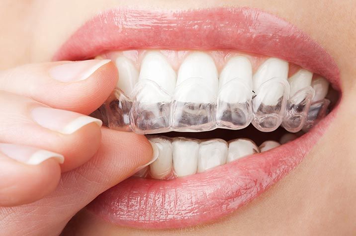Mouthguard for sensitive teeth