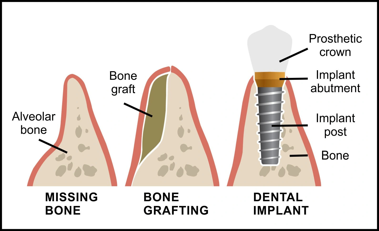 Diagram showing dental implant osseointegration process in jawbone for diabetic patients considering implant surgery in Jaipur
