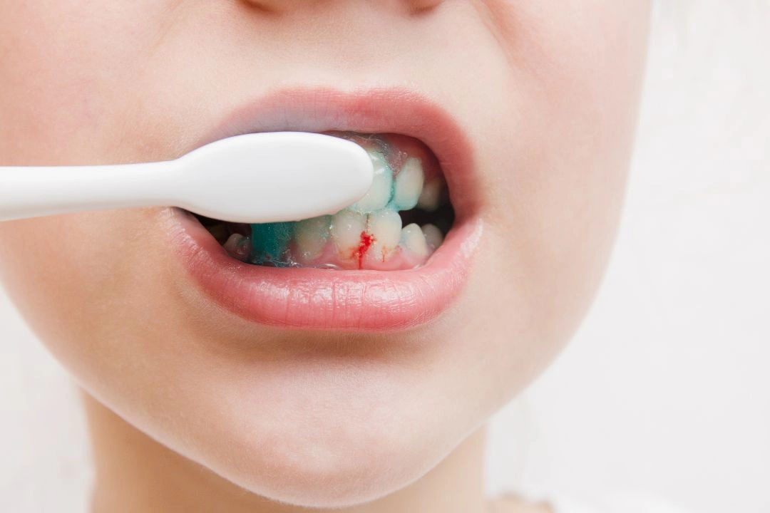 How to Treat Mild Gum Bleeding at Home (And When to See a Dentist) How to Treat Mild Gum Bleeding at Home (And When to See a Dentist)