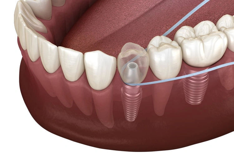 How to Clean Dental Implants Properly
