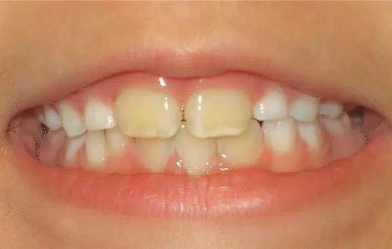 Why Does My Child’s Permanent Tooth Look Yellow Compared to Baby Teeth?