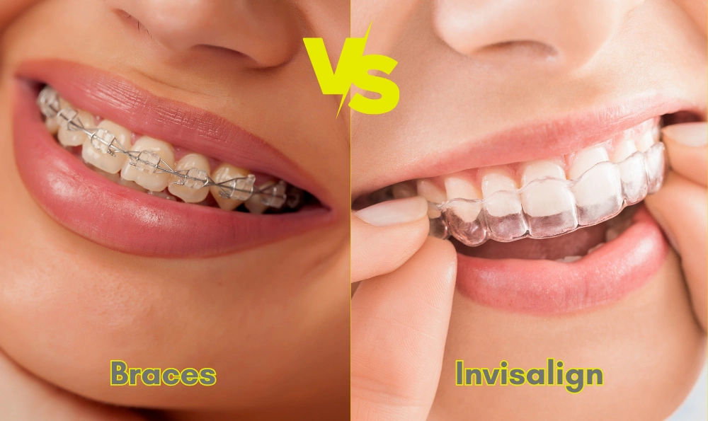 Invisalign vs Braces: Which One Is Right for You? Invisalign vs Braces: Which One Is Right for You?