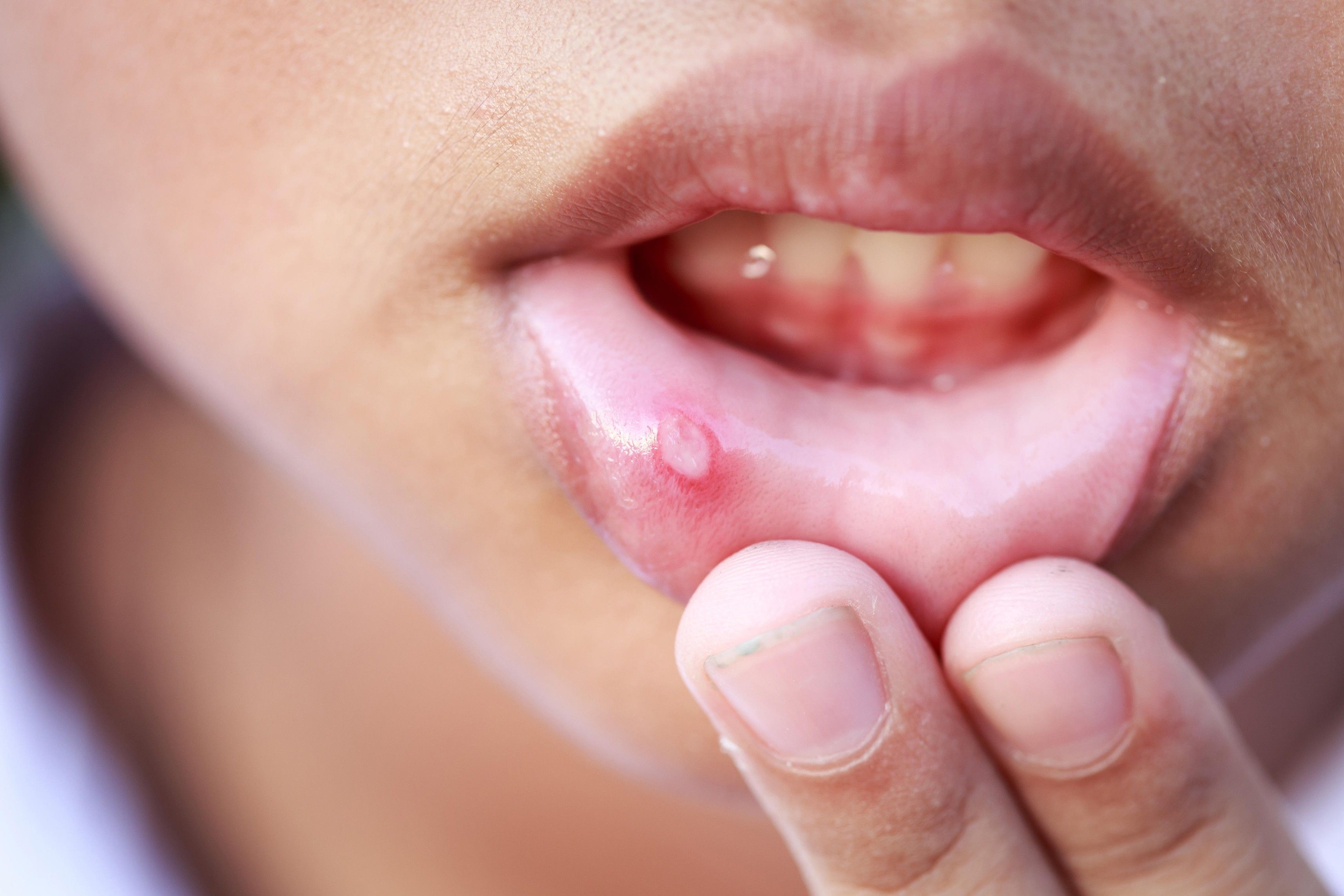 Effective Medicines For Mouth Ulcers A Comprehensive Guide To Relief