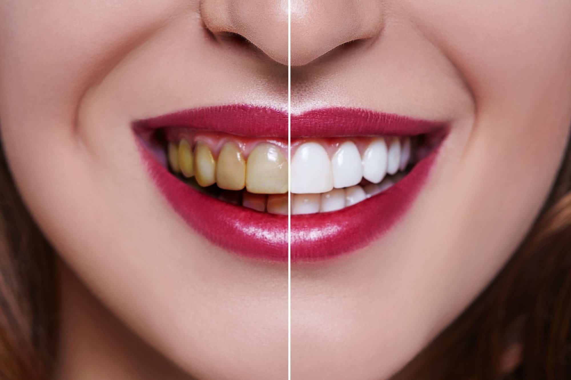 Achieve a Brighter Smile: Effective Tips for Teeth Whitening