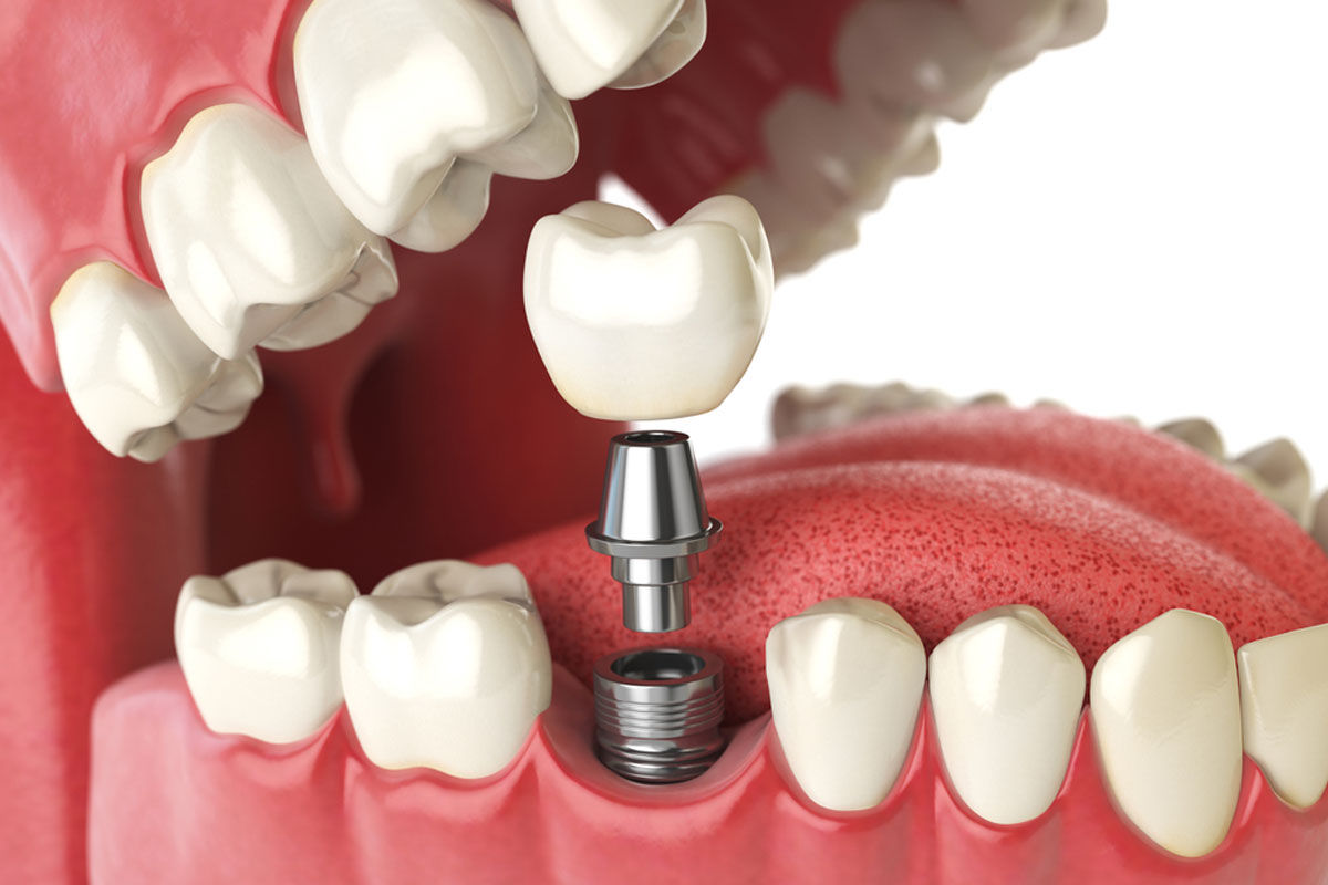 The Advantages of Dental Implant Treatment in Jaipur: A Smile Restoration Journey