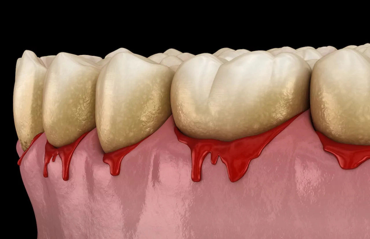 Why Gum Bleeding Should Never Be Ignored Why Gum Bleeding Should Never Be Ignored