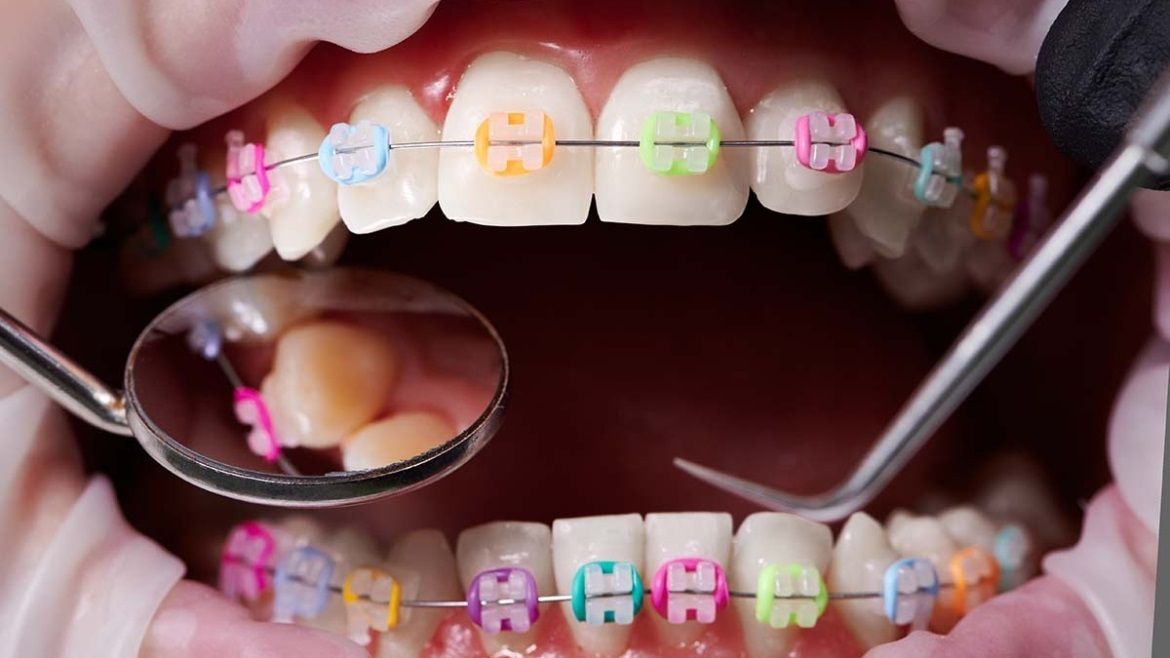 How To Tell If You Have A Cavity With Braces?