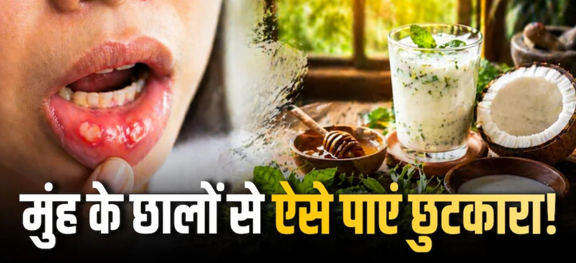 गर्मियों में मुँह के छालों (Mouth Ulcers) से हैं परेशान? अपनाएं ये उपाय! गर्मियों में मुँह के छालों (Mouth Ulcers) से हैं परेशान? अपनाएं ये उपाय!