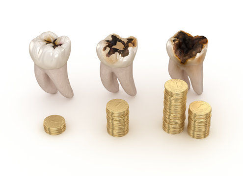 Dental Procedure Cost List in India: A Comprehensive Guide to Tooth Cap Cost