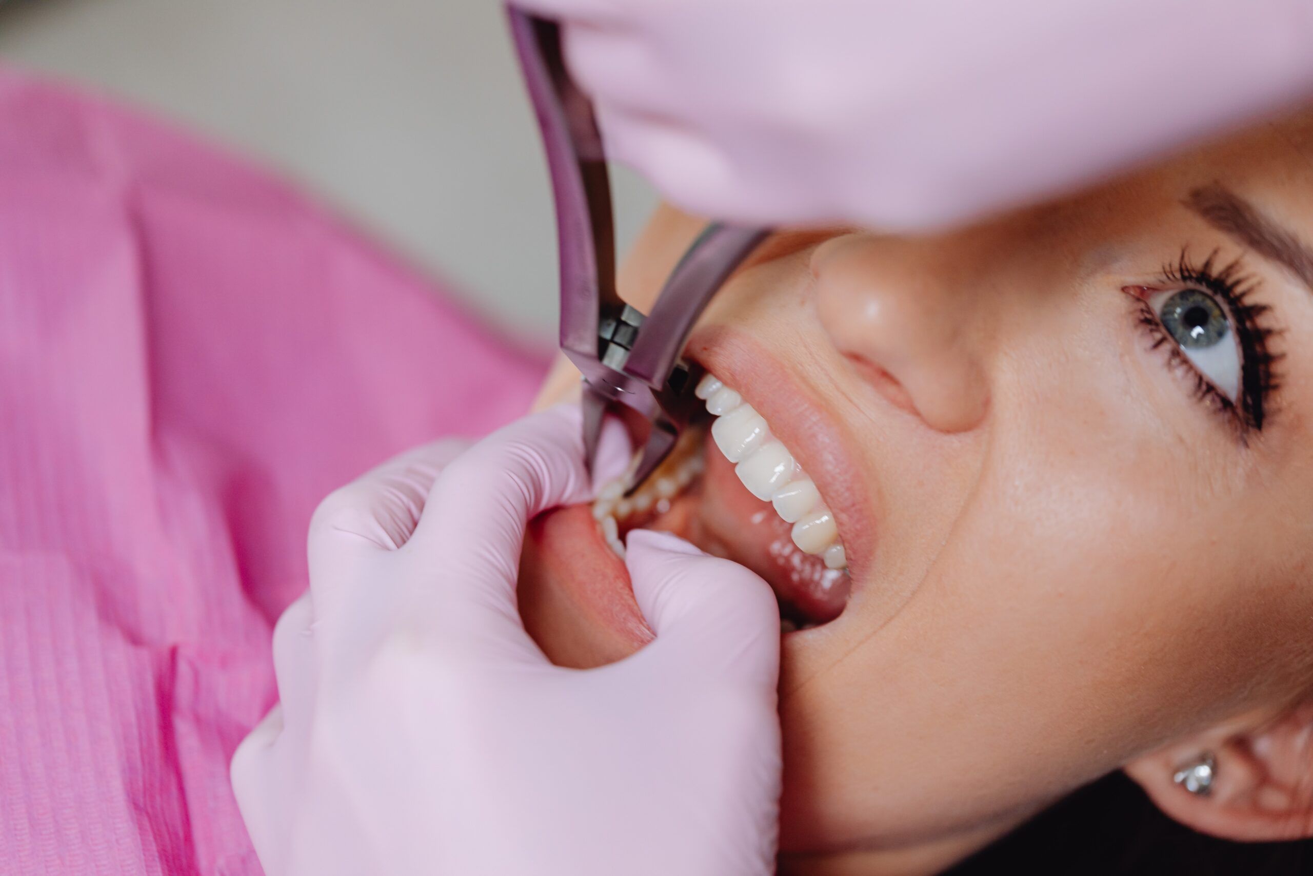 Understanding Wisdom Tooth Removal: What You Need to Know