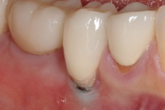 Peri implantitis (inflammation of tissues near dental implant)