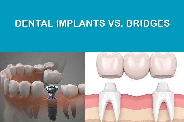 Dental Implants vs Bridges – What’s Better? Dental Implants vs Bridges – What’s Better?