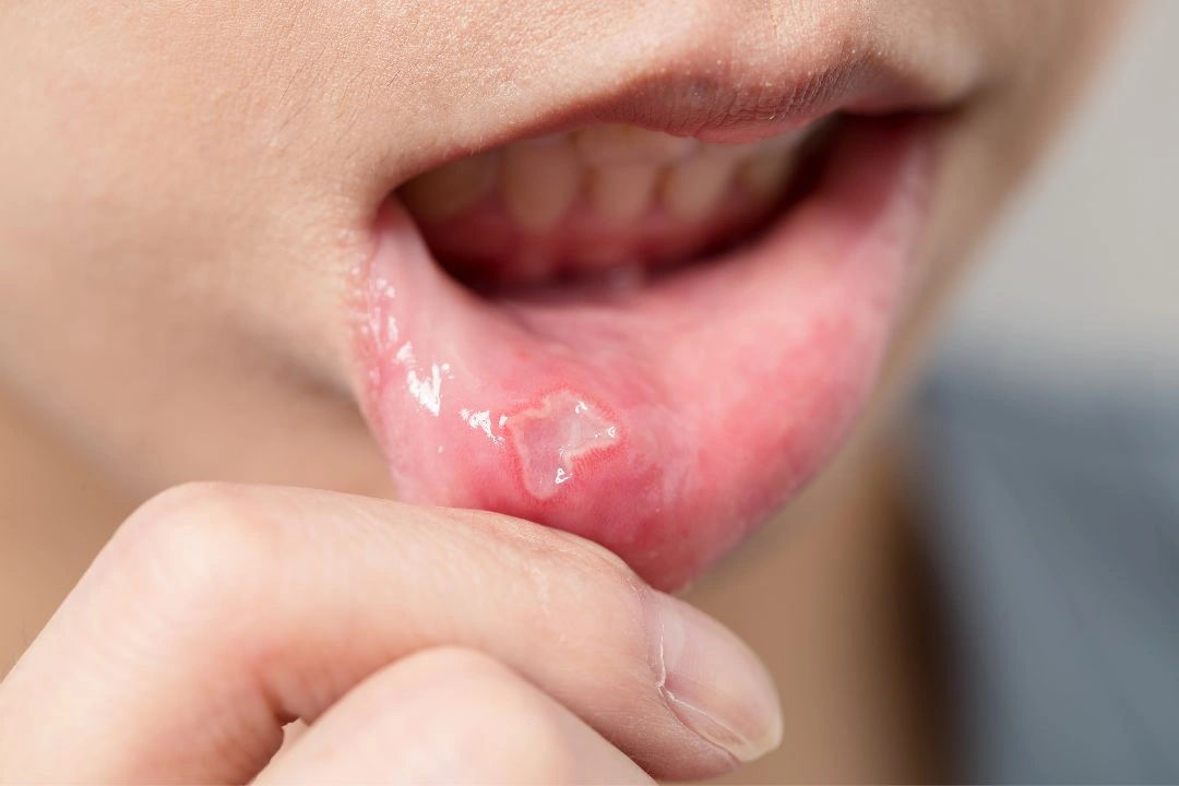 Mouth Lip Ulcer Treatment How To Heal And Prevent Recurrent Ulcers Mouth Lip Ulcer Treatment How To Heal And Prevent Recurrent Ulcers