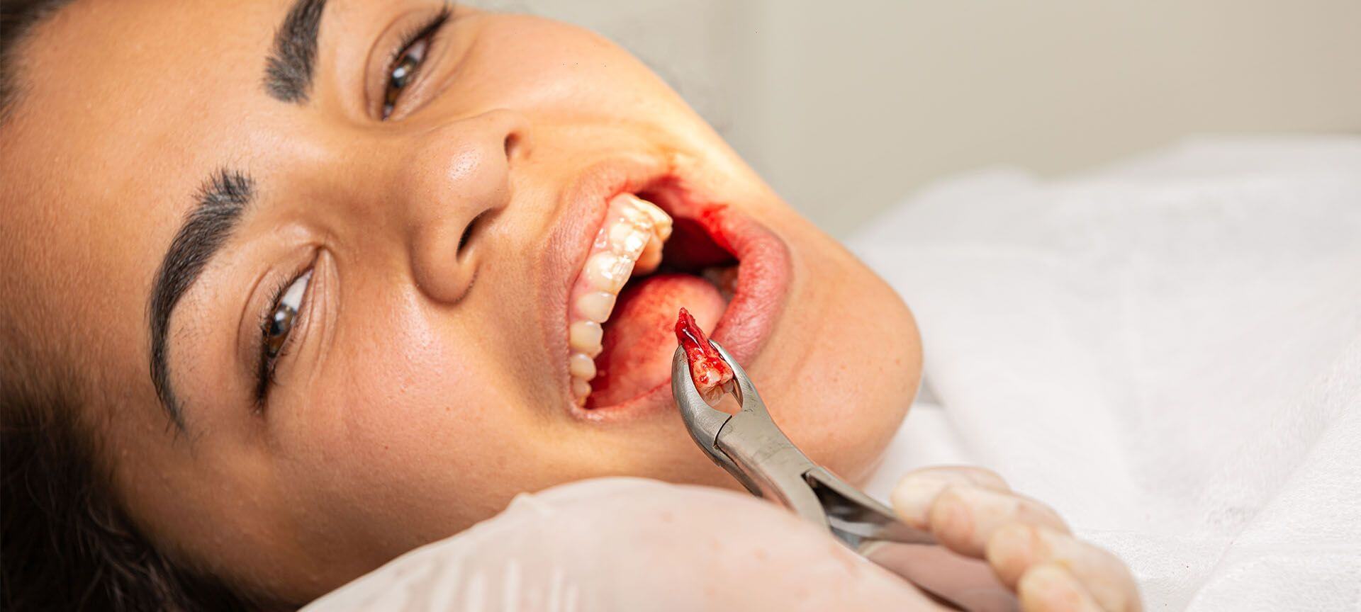जानें दांत निकलवाने के बाद किन-किन बातों का ध्यान रखना चाहिए?