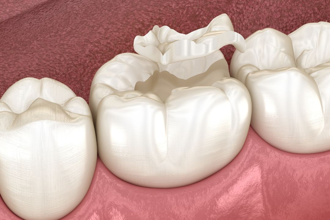 7 Important Things You Should Know Before Getting a Tooth Filling 7 Important Things You Should Know Before Getting a Tooth Filling