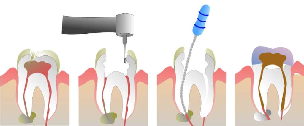 Demystifying Root Canal Treatment: Separating Fact from Fiction