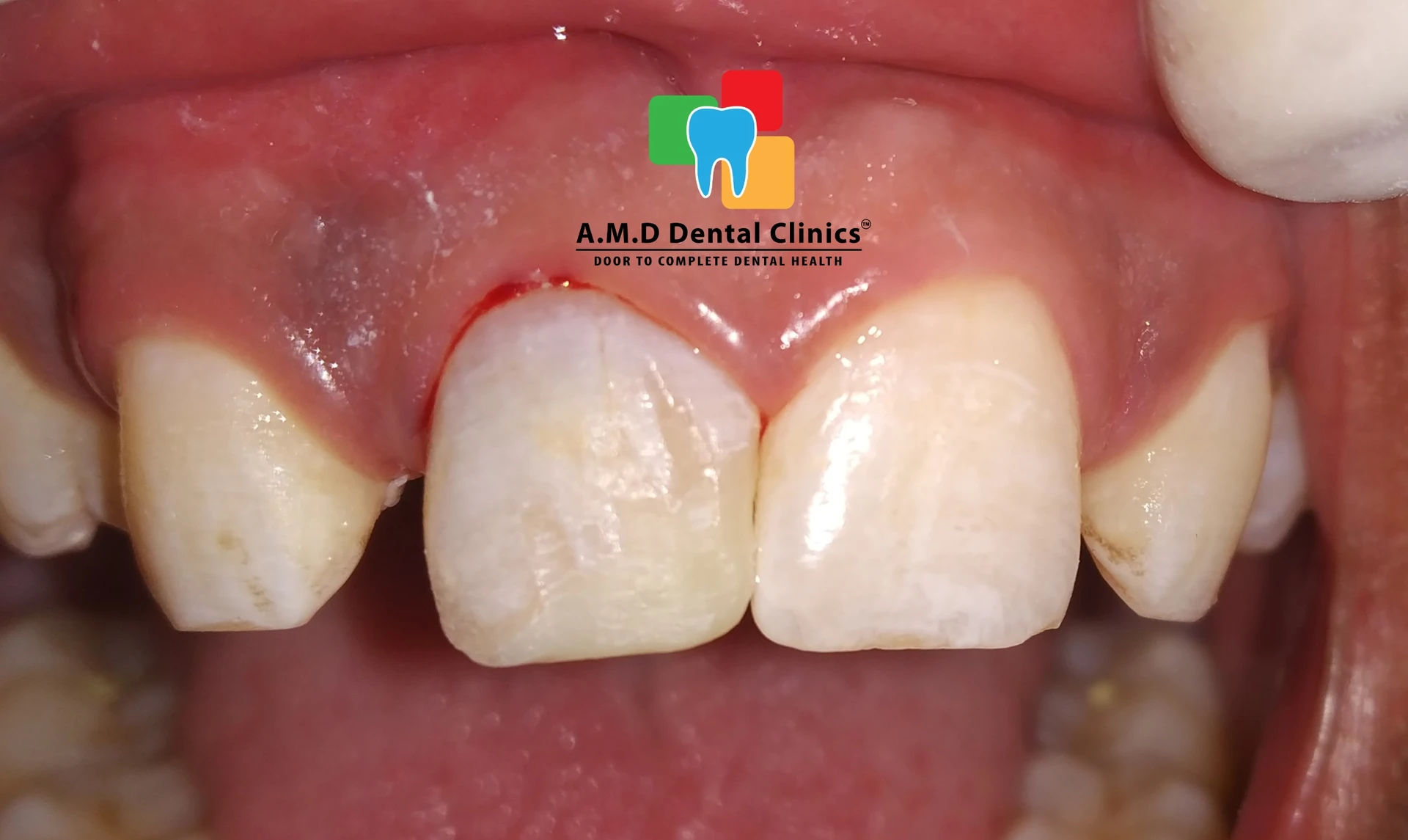 POST OPERATIVE IMAGE SHOWING ZIRCONIA CROWN