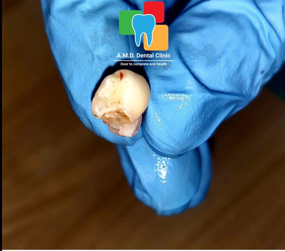 Extracted Deciduous First Molar