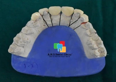 Dental Veneers and Zirconia Crowns