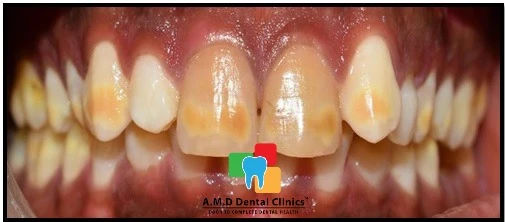 Pre Operative Image