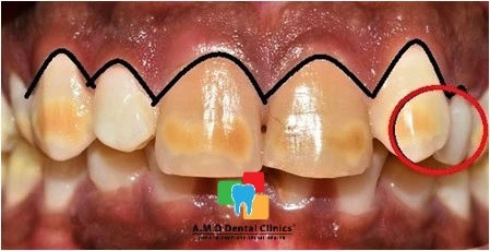 Pre Op:Transposed Canine and Gingival Zenith