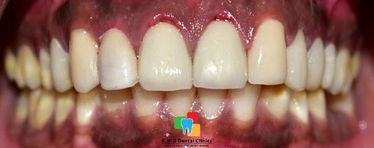 Post Operative Image