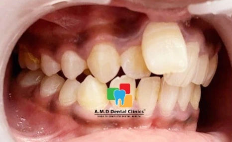 Pre Dental Braces Treatment Right Lateral View