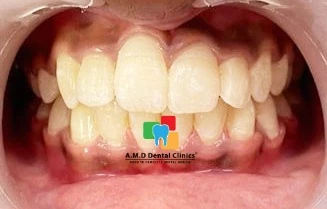 Post Metal Braces Treatment 