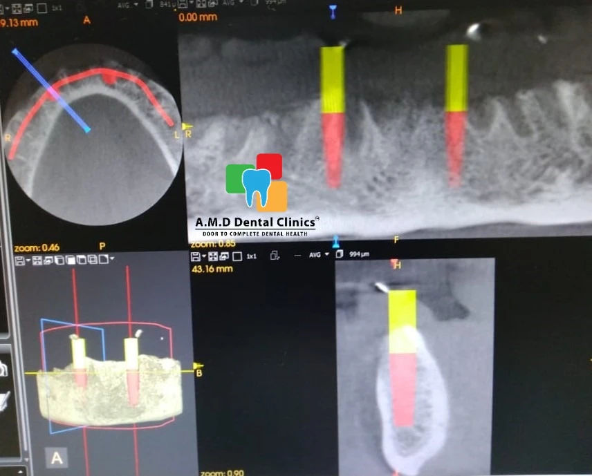 Dental Implant Site and Size Planned using CBCT Report