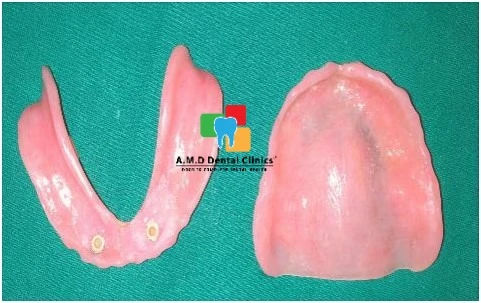 Two implant retained overdenture