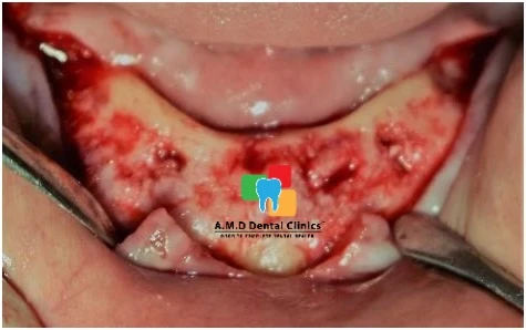 Surgical exposure of bone