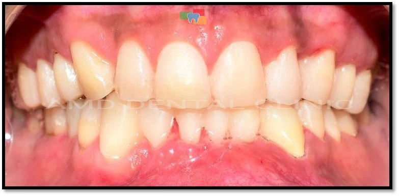 After: Smile Makeover with Teeth Veneer