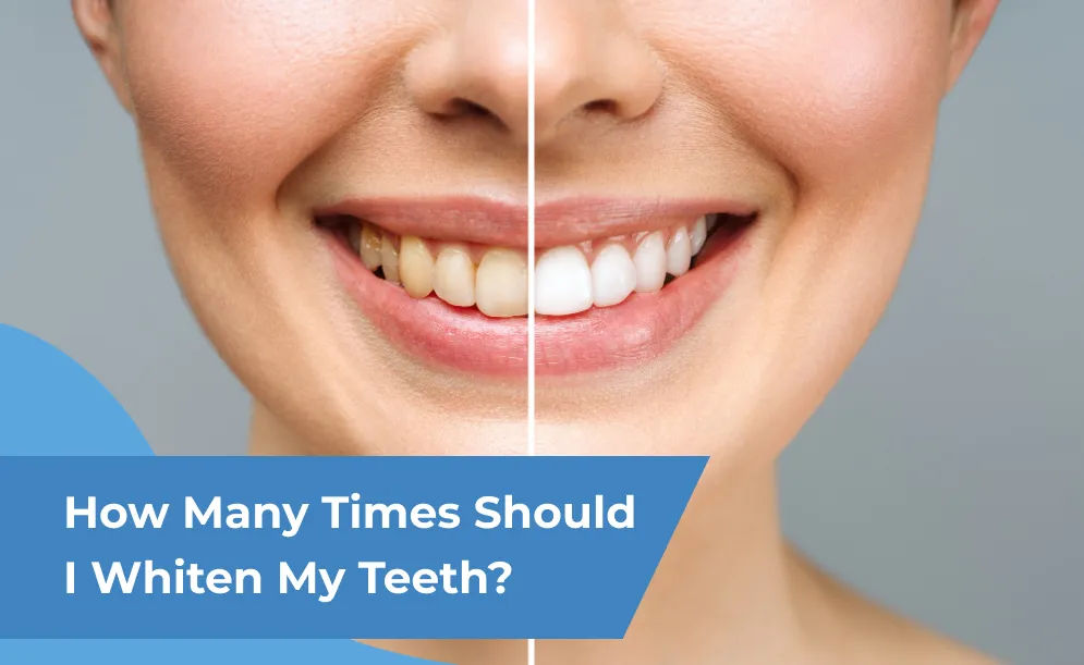 How Many Times Should I Whiten My Teeth?