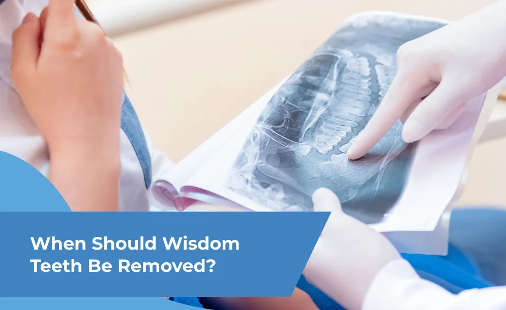 When Should Wisdom Teeth Be Removed?